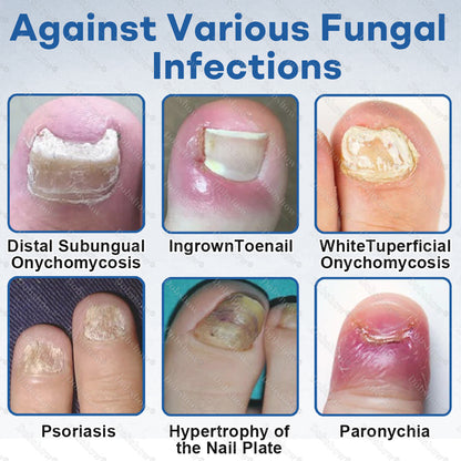 🔥Healrize®Nano Rapid Clear Nail Fungus Rapair Liquid – Effective in Seven Days, Permanently Eliminates the Root