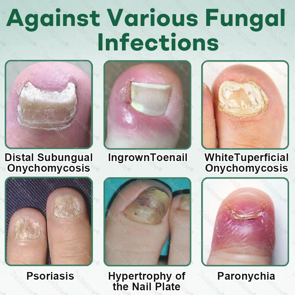 💅Healrize®Nano Rapid Clear Nail Fungus Rapair Liquid – Effective in Seven Days, Permanently Eliminates the Root 🔥