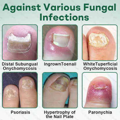 💅Healrize®Nano Rapid Clear Nail Fungus Rapair Liquid – Effective in Seven Days, Permanently Eliminates the Root 🔥