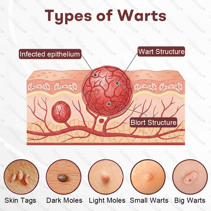 Healrize® BlackRice DermCorrect™ Wart Recovery Cream✨| Suitable for all skin types🌿