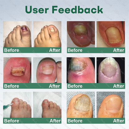 💅Healrize®Nano Rapid Clear Nail Fungus Rapair Liquid – Effective in Seven Days, Permanently Eliminates the Root 🔥