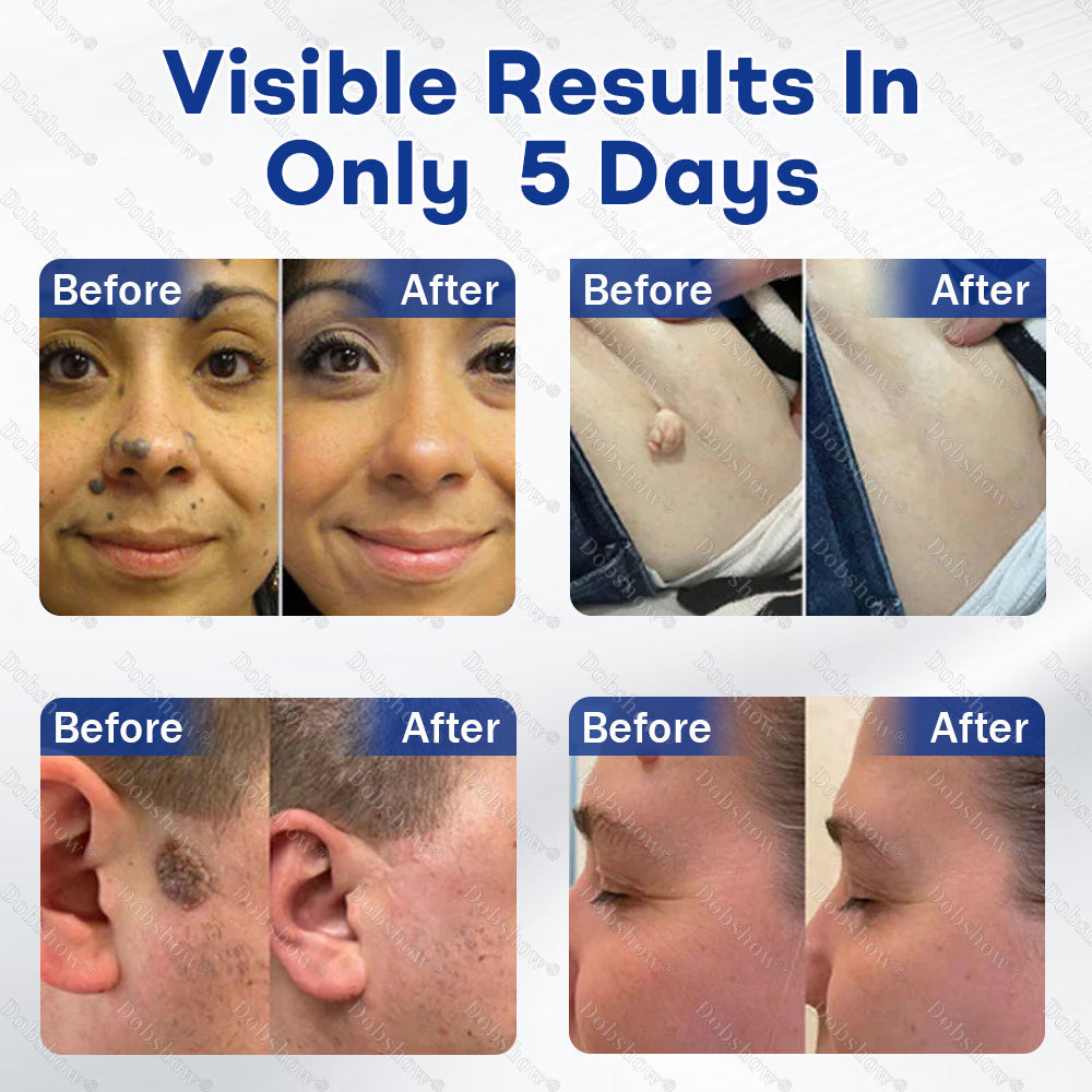 💥Best Seller🔥Dobshow® 3-in-1 Microneedle & Hydrocolloid Skin Tag Patch