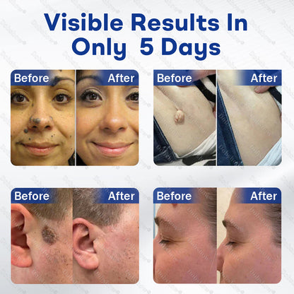 💥Best Seller🔥Dobshow® 3-in-1 Microneedle & Hydrocolloid Skin Tag Patch