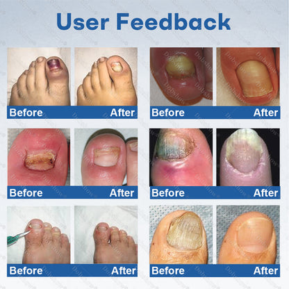🔥Healrize®Nano Rapid Clear Nail Fungus Rapair Liquid – Effective in Seven Days, Permanently Eliminates the Root