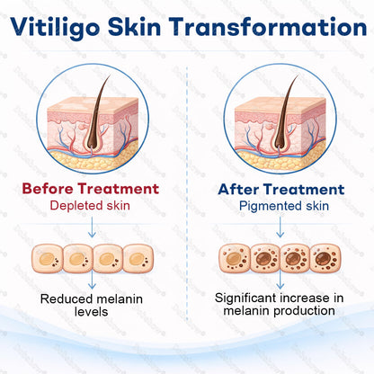 🔥Healrize® Piperine Vitiligo Repigmentation Spray - 👨‍⚕️✅Steroid-Free Botanical Formula | Gentle & Effective for All Skin Types