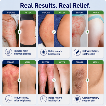 🏆Healrize® 2-in-1 Liposomal Mag-Ceramide Spray | 2-Min Rapid Relief for Psoriasis & Eczema (Full Body & Intimate Safe)